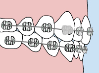 http://www.sesamehub.com/sesame_media/images/emergency-care/loose-bracket.jpg